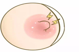 预防乳头念珠菌感染